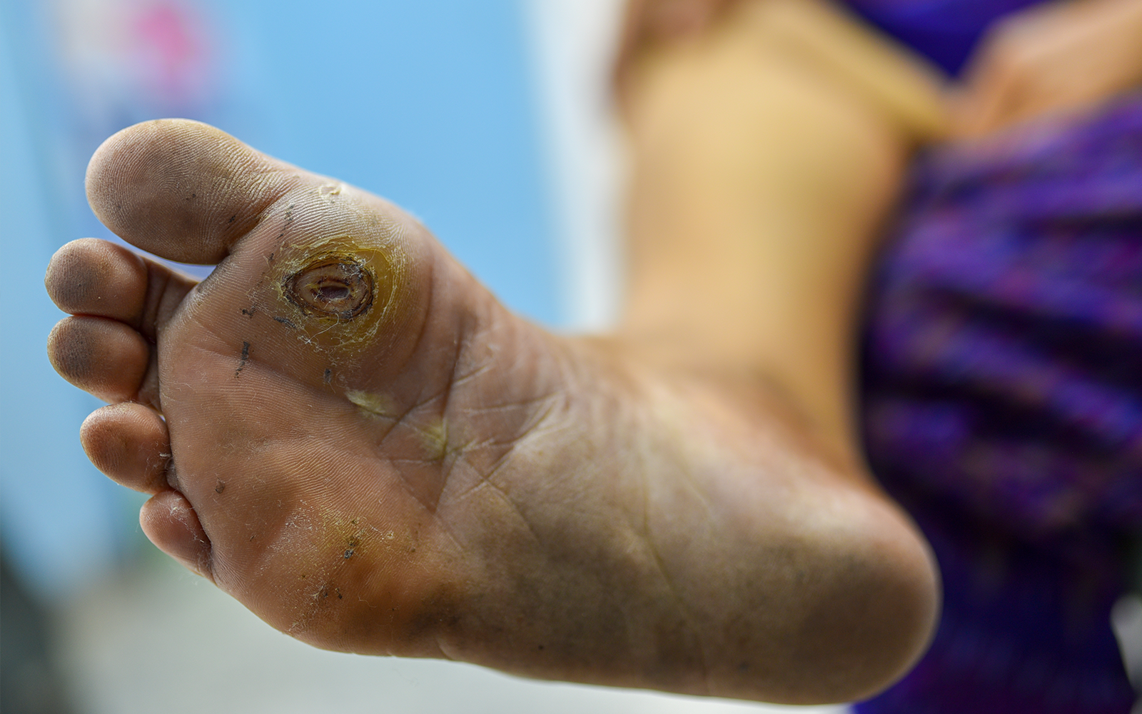 Diabetic Foot Treatment in Ahmedabad